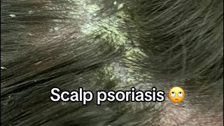 Scalp Psoriasis Removal [upl. by Rider]