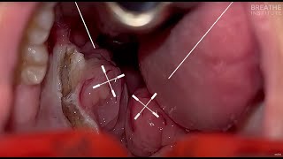 Grade 4 Tonsils with Dr Soroush Zaghi at The Breathe Institute  Pre and Post airway CBCT [upl. by Syxela559]