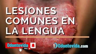 Lesiones comunes en la lengua Signos síntomas y tratamientos [upl. by Kenric809]