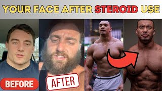 How you look AFTER steroids What steroids does to your face [upl. by Carmela108]