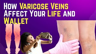 How Varicose Veins Affect Your Life and Wallet varicoseveins [upl. by Odlavso]