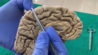 Dissection Sulci amp Gyri on Medial surface of brain [upl. by Airotcivairam112]