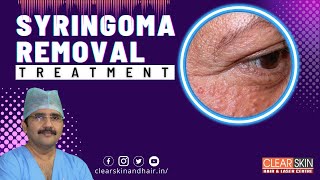 How To Treat Syringomas  Syringomas Removal Treatment  Clear Skin Hair and Laser Centre kurnool [upl. by Inneg]