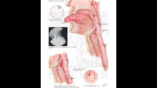 Plummer Vinson Syndrome [upl. by Adnohsed865]