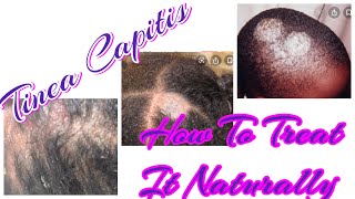 Tinea Capitis How To Treat It Naturally Diagnosedupdatetreatment [upl. by Nigrom]