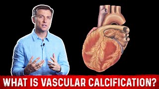 What Is Vascular Calcification – DrBerg [upl. by Ennovy]