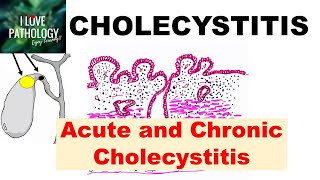 CHOLECYSTITIS Acute and Chronic Pathology and Complications [upl. by Cadel466]