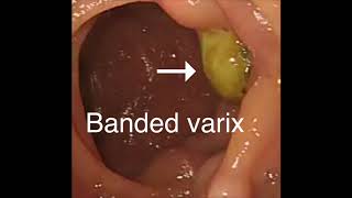 Obliteration of bleeding duodenal varices by EUSguided injection of Nbutyl2CA [upl. by Breena]