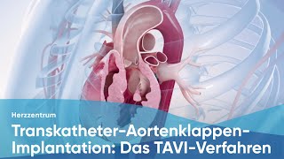 TranskatheterAortenklappenImplantation Das TAVIVerfahren [upl. by Estren]