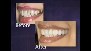 Prismatik Clinical Zirconia™ Crowns amp Bridges [upl. by Nide492]