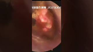 Ear pits and cerumen lumps earwaxremoval drzhao [upl. by Wagshul]