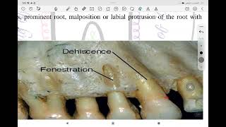 periodontology alveolar process مرحلة رابعة طب اسنان [upl. by Enimisaj]