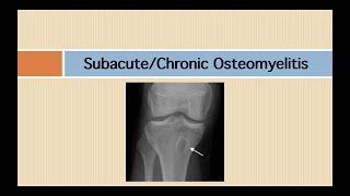 Subacute and chronic osteomyelitis [upl. by Karlens]