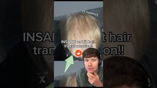 INSANE 5 MONTH HAIR LOSS TRANSFORMATION 🤯 hairloss shorts [upl. by Noiz]