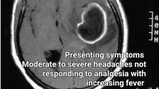 Brain abscess [upl. by Warthman]