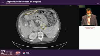 Diagnostic de la cirrhose en imagerie  R Sartoris [upl. by Lilahk606]