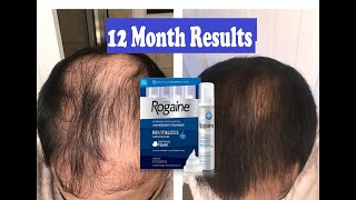 Does Rogaine REALLY Work 12 Month RESULTS  MENS ROGAINE 5 Minoxidil Hair Regrowth Treatment [upl. by Adile]