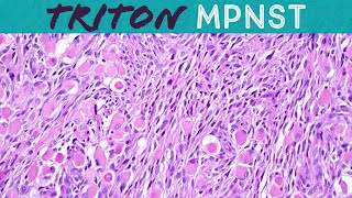 Malignant Triton tumor MPNST with rhabdomyosarcoma differentiation Basic soft tissue pathology [upl. by Neddy]