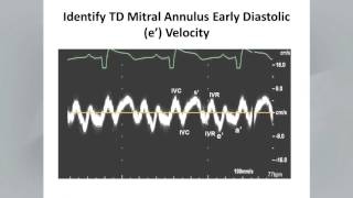 Recommendations for the Evaluation of LV Diastolic Function [upl. by Quartas119]