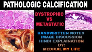 PATHOLOGIC CALCIFICATION  Dystrophic vs Metastatic Calcification [upl. by Eduam]