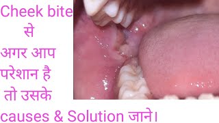 Cheek bite  chronic cheek bite Causes of cheek bite and its solution morsicatio buccarum क्या [upl. by Suirradal]