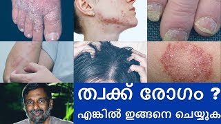 Psoriasis  Skin diseases treatment  Mohanan Vaidyar [upl. by Tomasine]