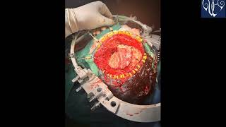 PLANUM SPHENOIDALE MENINGIOMA EXCISION  DR VIJAYMAHANTESH PUJARI [upl. by Morvin732]