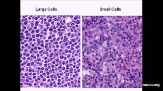 What You Need to Know about NonHodgkins Lymphoma Presentation [upl. by Tarfe972]