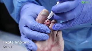 OSSIOfiber Hammertoe Fixation System Surgical Technique with Mark Prissel DPM [upl. by Nwadahs239]