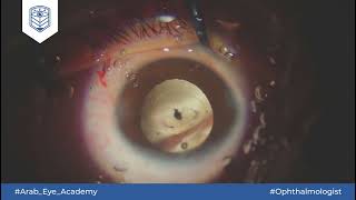 Educational Video 16 Posterior polar cataract by AEA [upl. by Yarahs]