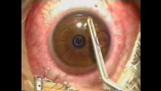 Lasik Laser Eye Surgery Procedure  Live Surgery [upl. by Hube]