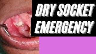 How to treat a Dry Socket drysocket [upl. by Ontine]