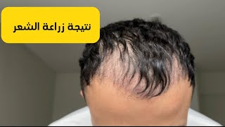 نتيجة زراعة الشعر بالسويد بعد ثلاث اشهر و جلسات البلازما قريبا [upl. by Annaesor]