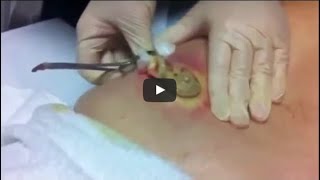 Biggest Pimple Pop Ever Caught On Camera Guiness World Record [upl. by Adnorehs]