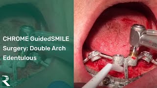 CHROME GuidedSMILE Edentulous Double Arch Surgery  CHROME Training Center Puebla [upl. by Wanonah386]