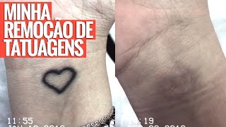 TUDO SOBRE MINHA REMOÇÃO DE TATUAGEM [upl. by Harberd845]