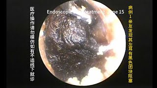 Suddenly discovered a relatively large cerumen embolism [upl. by Urian]