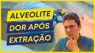 ALVEOLITE  O QUE CAUSA COMO TRATAR [upl. by Ellan]