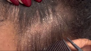 Flaky Eczema Scalp extreme close up ASMR [upl. by Horsey386]