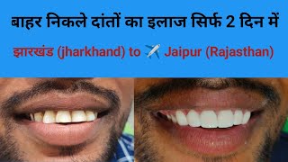 बाहर निकले दांतों का इलाज सिर्फ 2 दिन में परमानेंट jharkhand झारखंड to jaipur for smile makeover [upl. by Nyrahs]