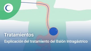 Explicación del Balón Intragástrico [upl. by Rramaj]