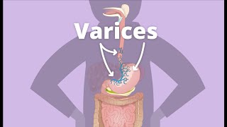 Cirrhosis – Varices [upl. by Anelac]