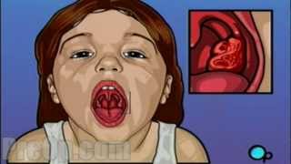 Tonsillectomy Surgery PreOp® Patient Education HD [upl. by Anaejer]