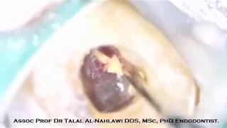 Furcation perforation repair by Assoc Prof Dr Talal AlNahlawi د طلال النحلاوي [upl. by Adnak292]