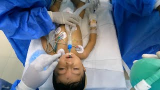 Pediatric Anesthesia Intubation Lessons  Anesthesiologist POV [upl. by Anrak]