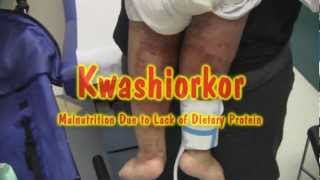 Kwashiorkor [upl. by Rogovy]