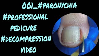 001 paronychia professional pedicure decompression video [upl. by Lottie]