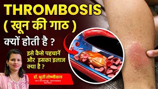 What is Thrombosis Whos at Risk and How to Prevent Blood Clots  Dr Shruti Toshniwal [upl. by Rawden870]