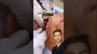 Large Salivary Gland Stone Removal [upl. by Eelinej]