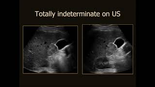 Liver Tumors The Fundamentals of Interpretation with CEUS [upl. by Blase]